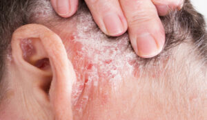 Psoriasis: एक जानलेवा त्वचा रोग जिसका इलाज अभी तक नहीं, संभव है सिर्फ नियंत्रण ही