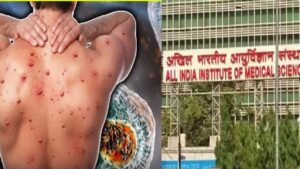 AIIMS Guidelines About Monkeypox: भारत के लिए बड़ा खतरा! AIIMS ने मंकीपॉक्स से निपटने के लिए जारी की गाइडलाइन्स