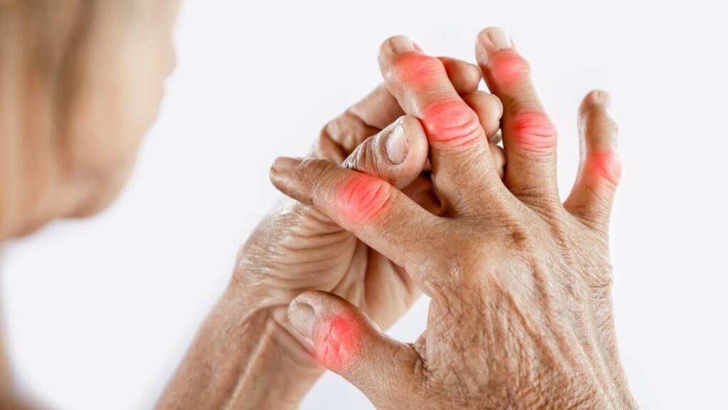 Arthritis Prevention Tips: गठिया से बचने के लिए अपनाएं ये आसान उपाय, जॉइंट पेन दूर रखें