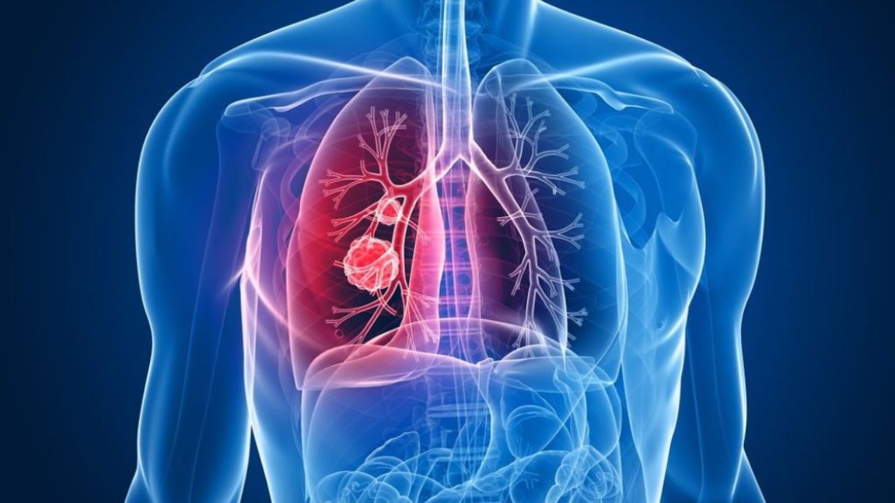 Lung Cancer: दिल्ली-NCR की प्रदूषित हवा में बढ़ा फेफड़ों के कैंसर का खतरा, जानें घर पर टेस्ट का तरीका