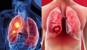 Lung Tumor Symptoms : फेफड़ों में ट्यूमर के संकेत, क्या आप भी इन्हें नजरअंदाज कर रहे हैं?