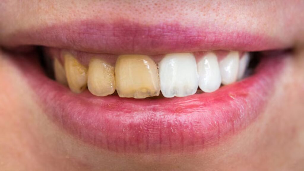 World Oral Health Day: दांतों पर जमा पीलापन हटाने के लिए अपनाएं ये आसान उपाय